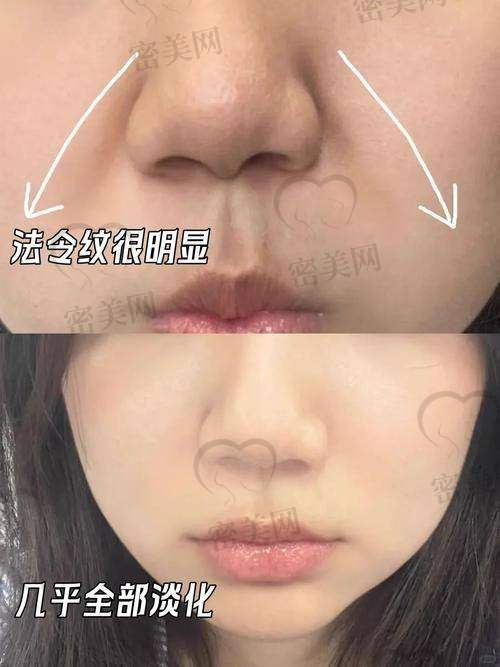 瑞蓝填充法令纹的小技巧