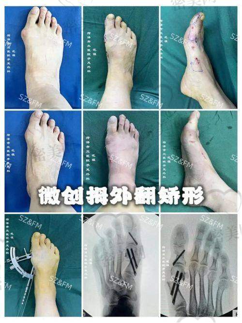 真人實(shí)例：見(jiàn)證大腳骨矯正的奇跡