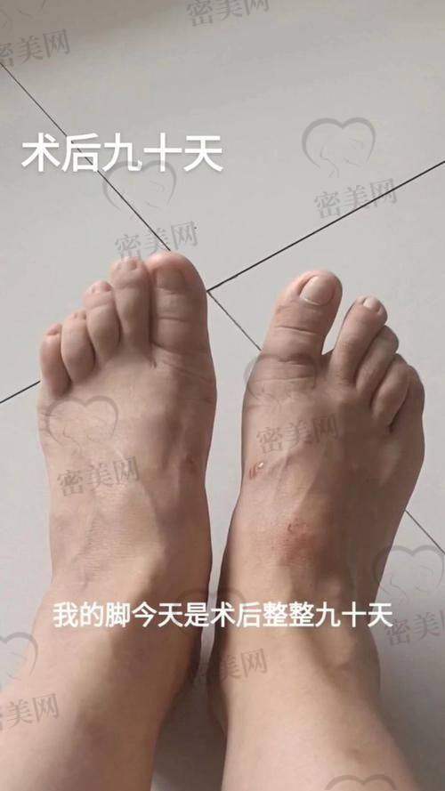 上海海華醫(yī)院：靠譜的大腳骨矯正圣地