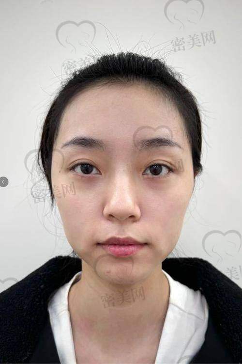 泪沟填充能维持几年