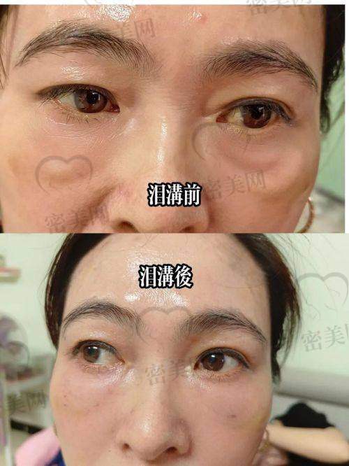 泪沟填充费用多少