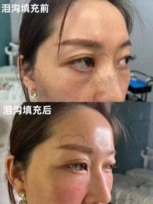 填充泪沟有啥风险
