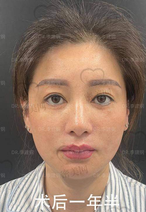 上海海华医院余光网指肪室网络复位的超棒口碑评价