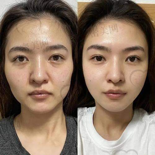 上海海华医院余光网指肪室网络复位：40000 元起的美丽魔法价格