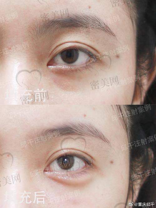 眼窝凹陷原因大揭秘