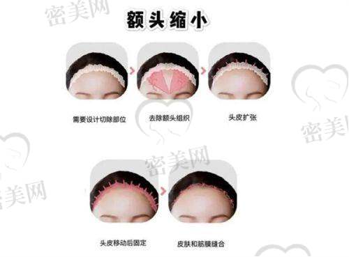 张超下颌角、面部轮廓整形技术究竟牛在哪？