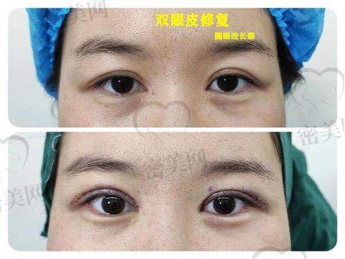 成都晶肤医美医院：打造“妈生感”眼型界的代表