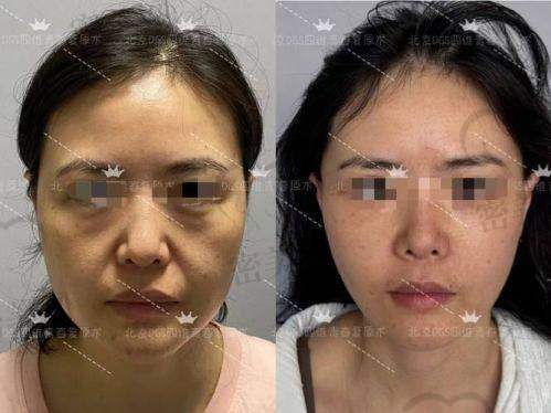 手术当天流程：每一步都清清楚楚