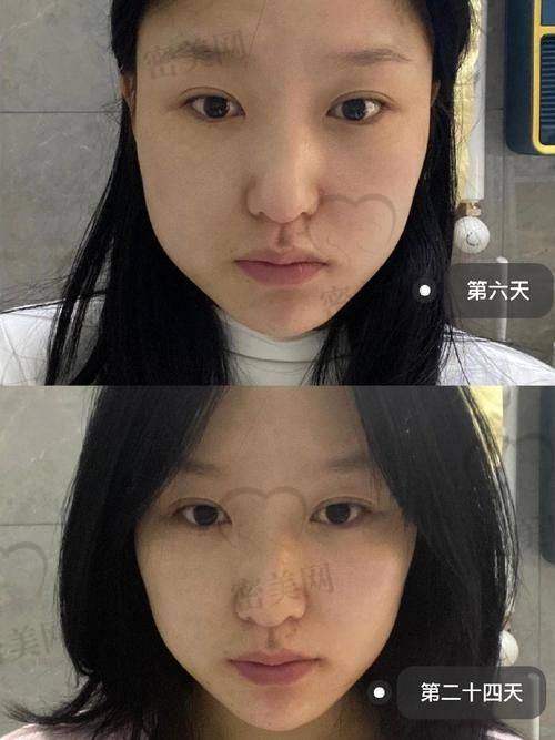 打瘦脸针的注意事项