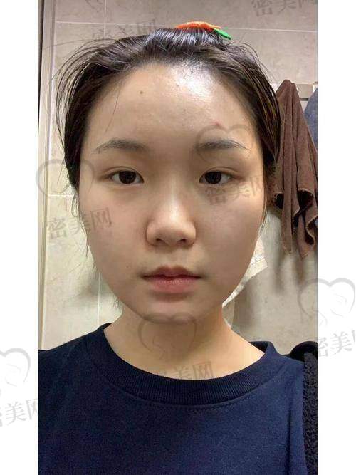 韩国与美国瘦脸针的差异