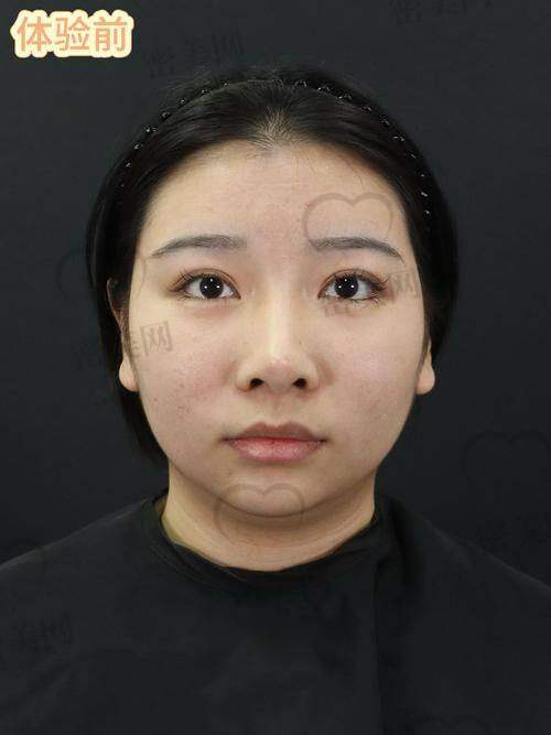 适合找刘金超医生做下颌角截骨的求美人群
