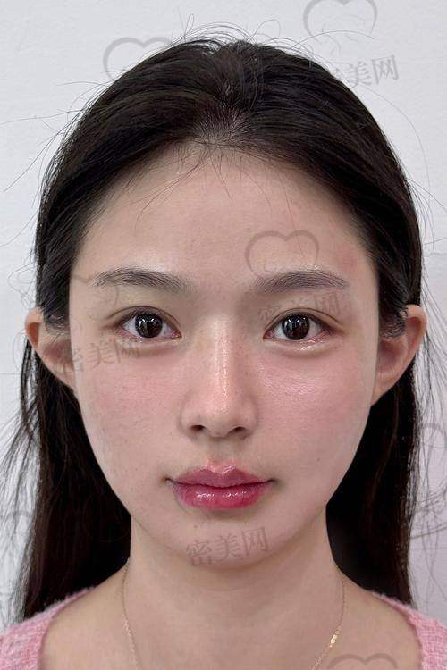 怎么选适合自己的玻尿酸？
