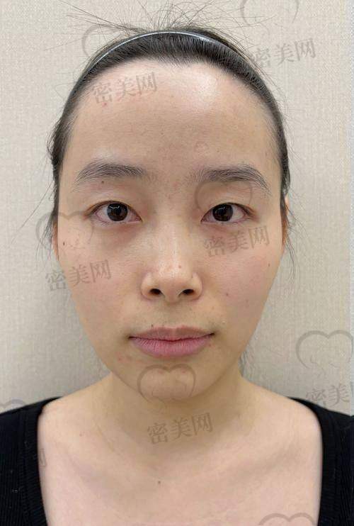 打玻尿酸有啥风险和注意事项？