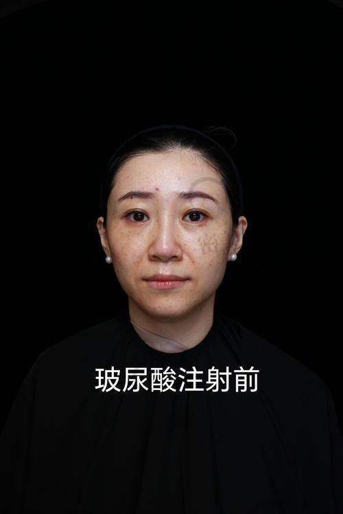 常见玻尿酸品牌价格大揭秘