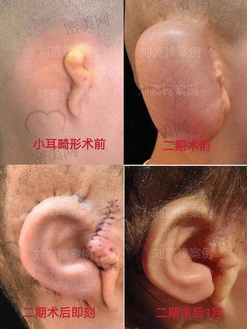 真人实例：上海海华医院安洪宾耳再造的神奇见证