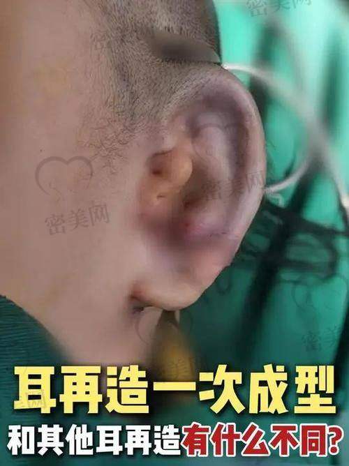 上海海华医院安洪宾耳再造的技术优势大揭秘