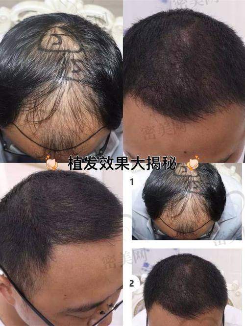 上海莱森植发中 心：显微镜下的精细之美