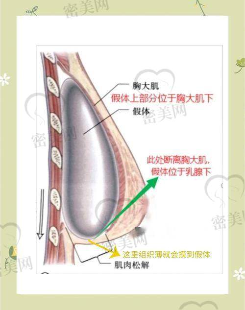 曼托假体优势让我直呼“真香”