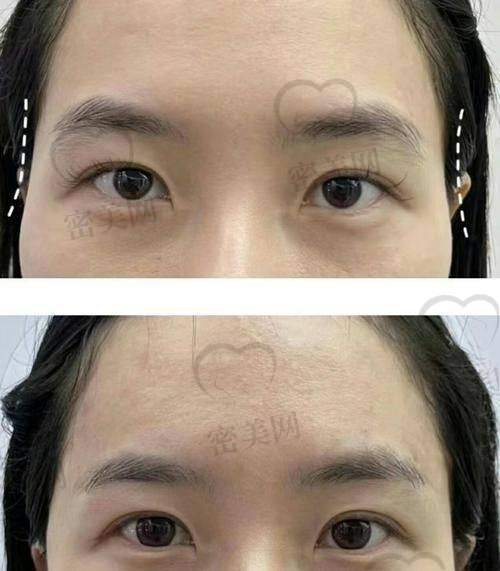填充太阳穴有啥副作用