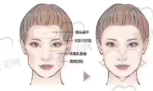 填充后多久能修复自然？