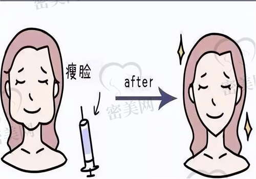 蹇洪医生的苹果肌复位术：轮廓年轻靠它，术后自然不突兀