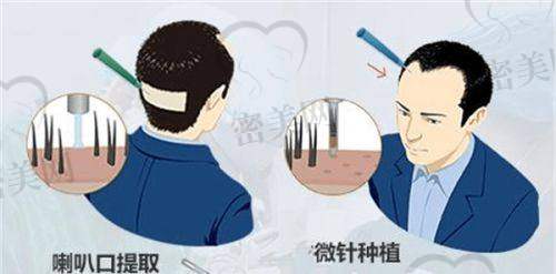 福州重森植发医院口碑怎么样？