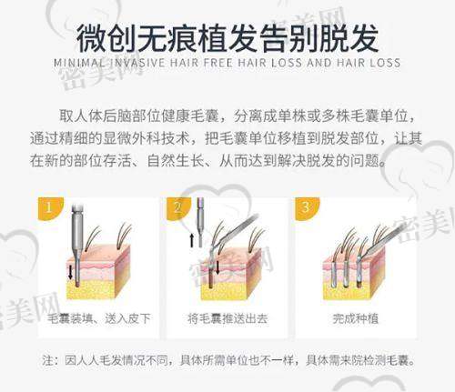 厦门重森植发医院特色项目：