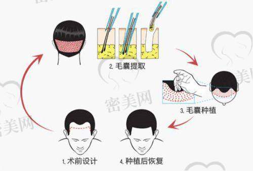 福州重森植发医院是正规的吗？