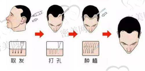 泉州重森植发价格表：