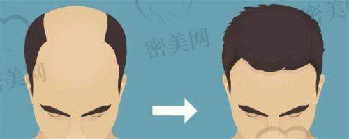 福州重森植发医院价格表：