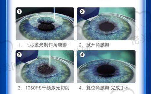 白内障手术费用详解：从单焦点到三焦点人工晶体应有尽有