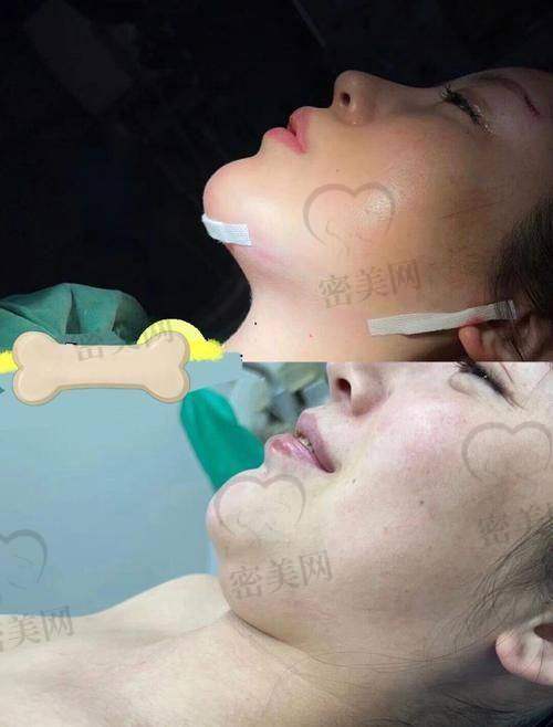 俞哲元医生的魔法：下颌角整形优势大揭秘