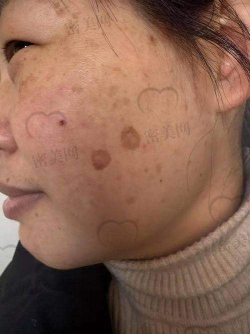 深圳卓美医疗美容门诊部：极速点斑黑科技，击破斑色边界