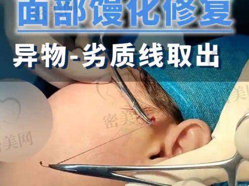 武汉艺星医疗美容医院（医生：徐国建）