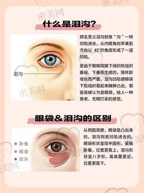 做泪沟手术多少钱
