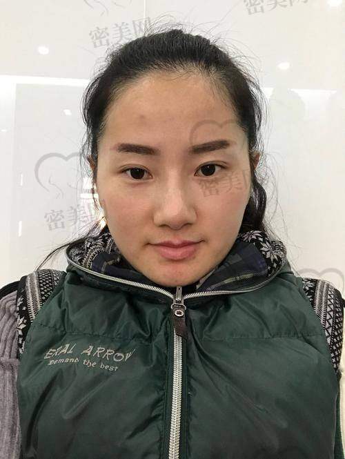 上海海华医院：自体脂肪填充的理想之选