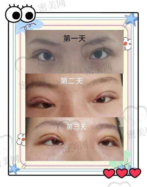 天津紫洁医疗美容郭栓全不开刀双眼皮：真人实例见证奇迹