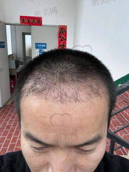 福州重森植发医院怎么样？