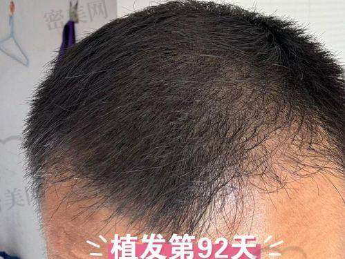 厦门万禾丽生植发医院特色项目：