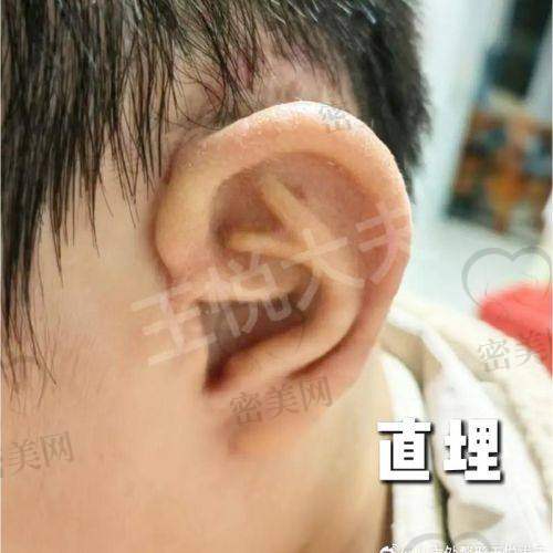 上海海华医院张群耳再造：口碑爆棚的秘密