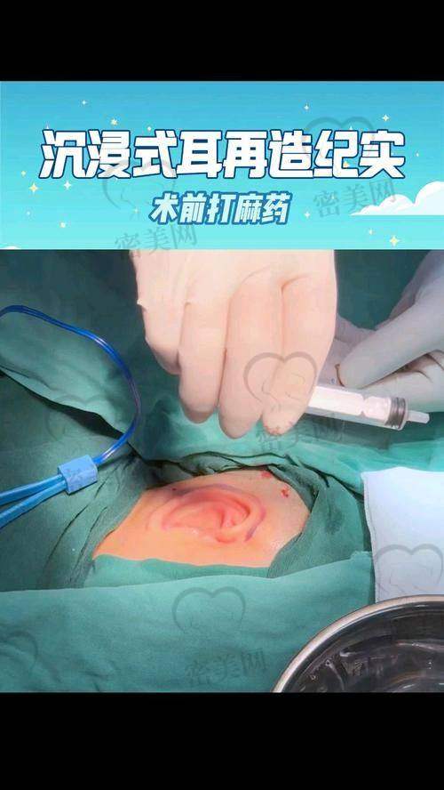 上海海华医院张群耳再造：技术优势大揭秘