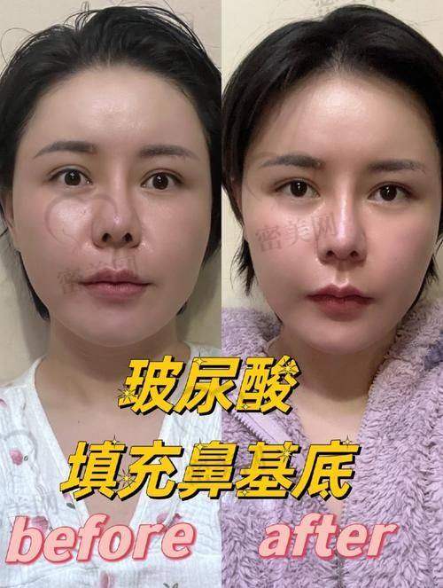 鼻基底凹陷填充有哪些“法宝”