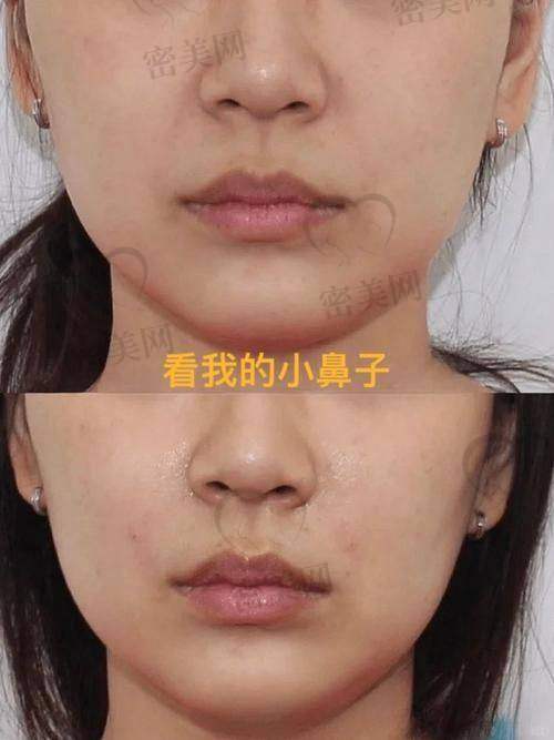 鼻基底凹陷填充费用大揭秘