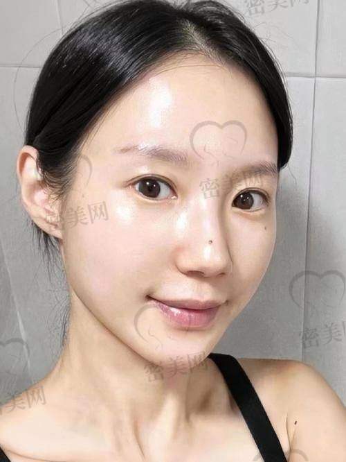 术后3年依然在线的美丽维护实例展示