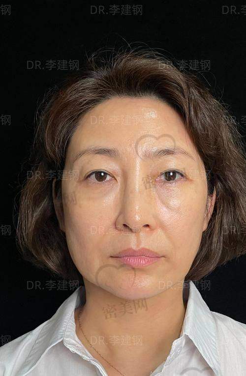 术后修复反馈：变得更美快、伤口隐蔽、无需长期请假