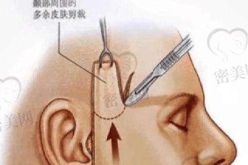 钦州华美整形医院祛眼袋多少钱?内切/外切/激光方式全都有