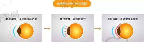 近视手术与白内障治疗价格透明吗？