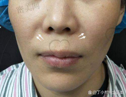 整形医院活动助力消除法令纹