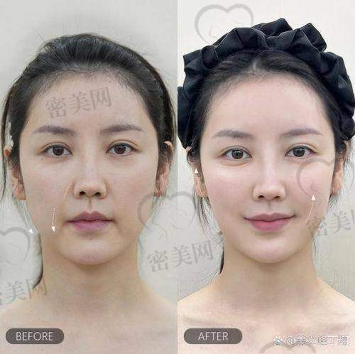 医美产品价格信息与法令纹填充