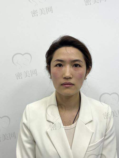 整容攻略中的法令纹消除方法